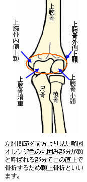 上 腕骨 顆 上 骨折